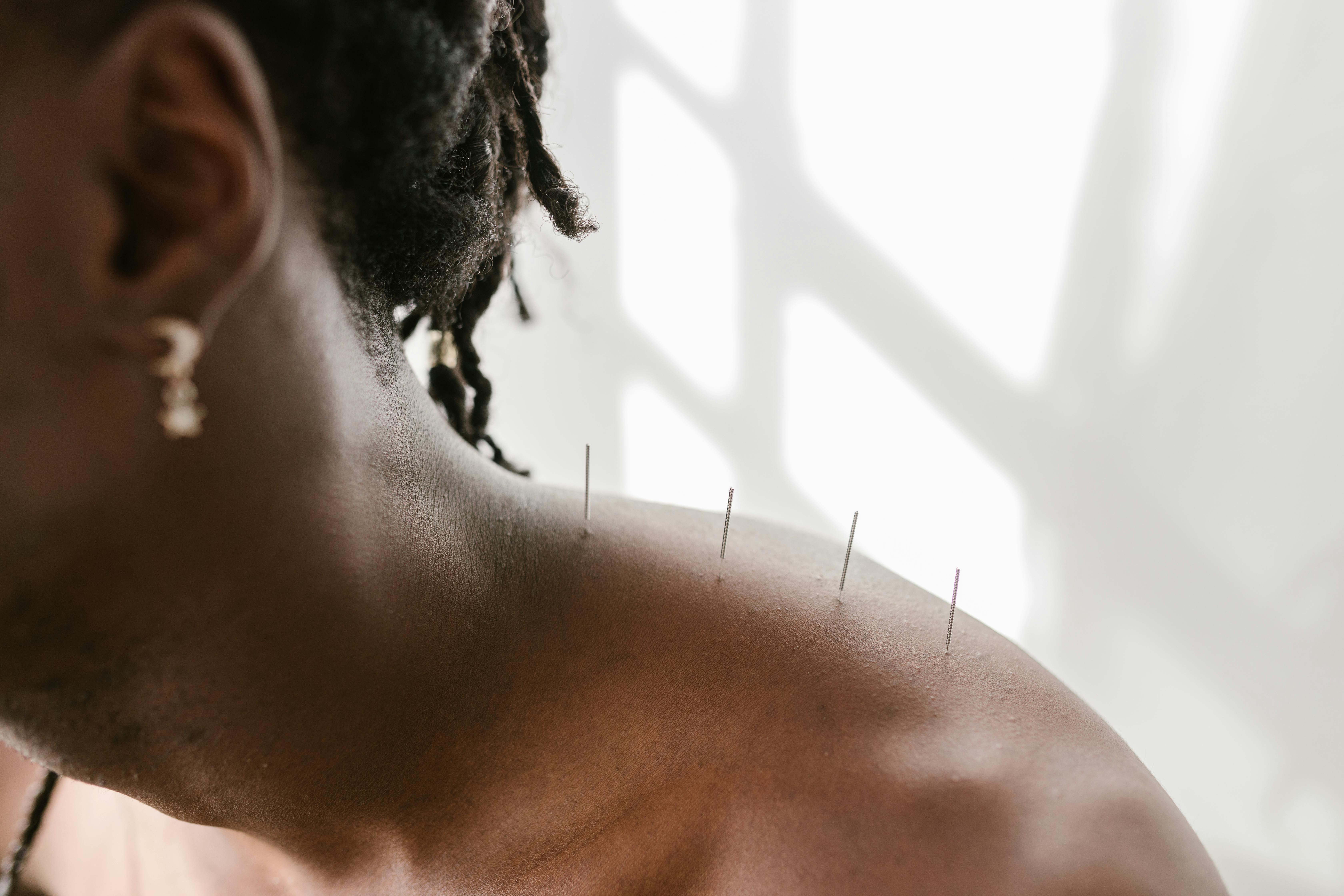 Close-up view of a patient’s shoulder with acupuncture needles placed along carefully selected points