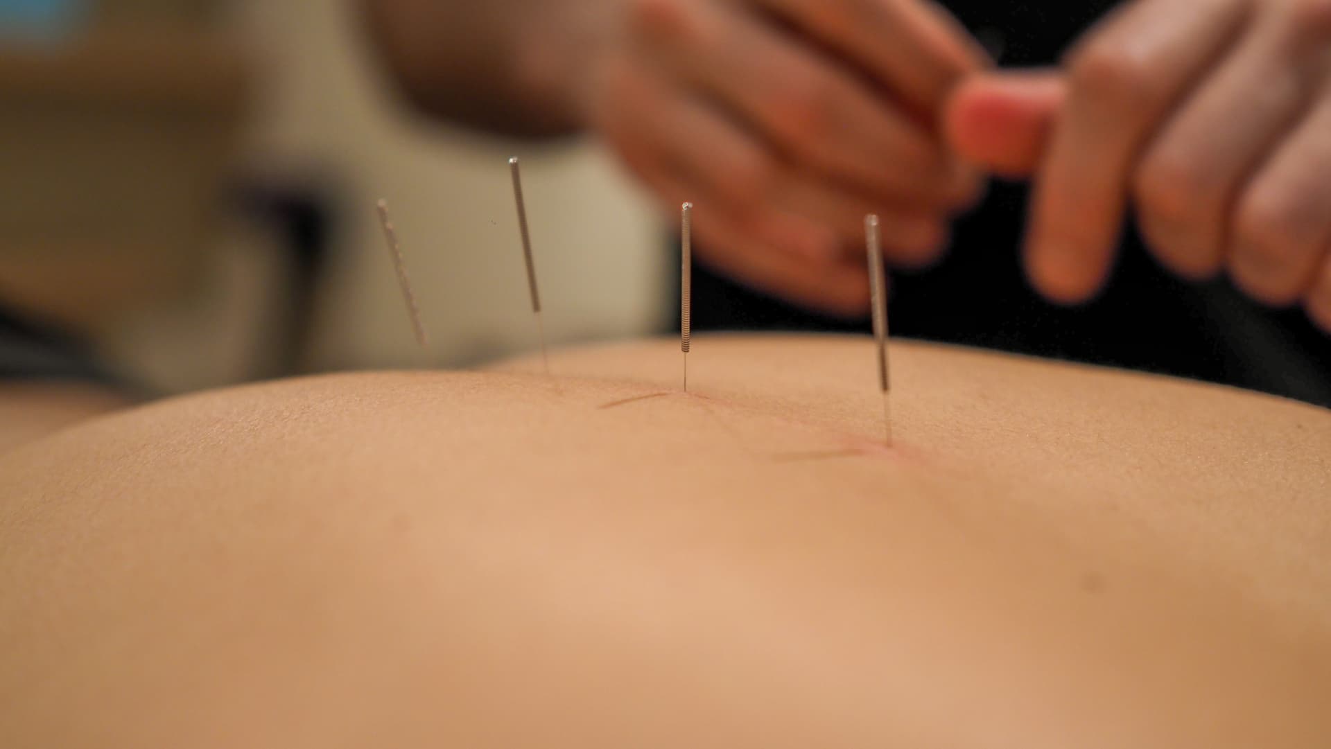 Photo of a practitioner inserting multiple acupuncture needles in a patient's back
